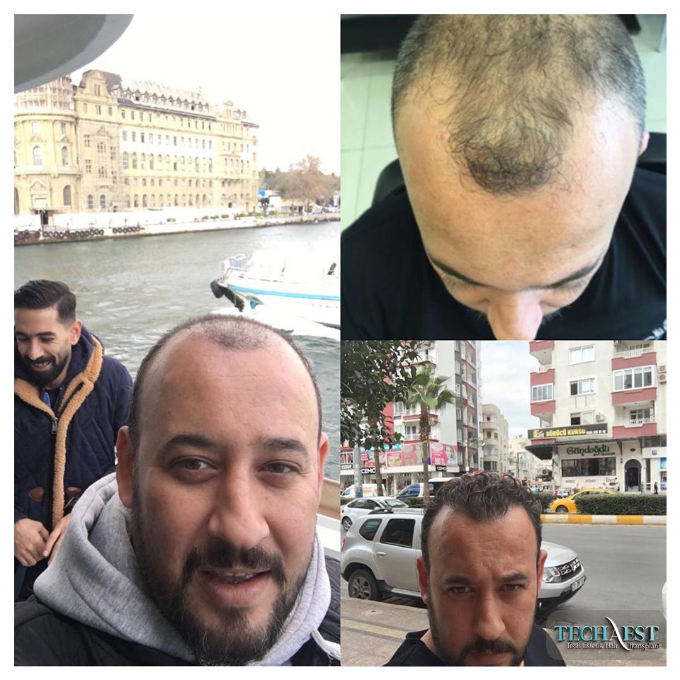 Tech Estetik Saç Ekim Sonuçları 02