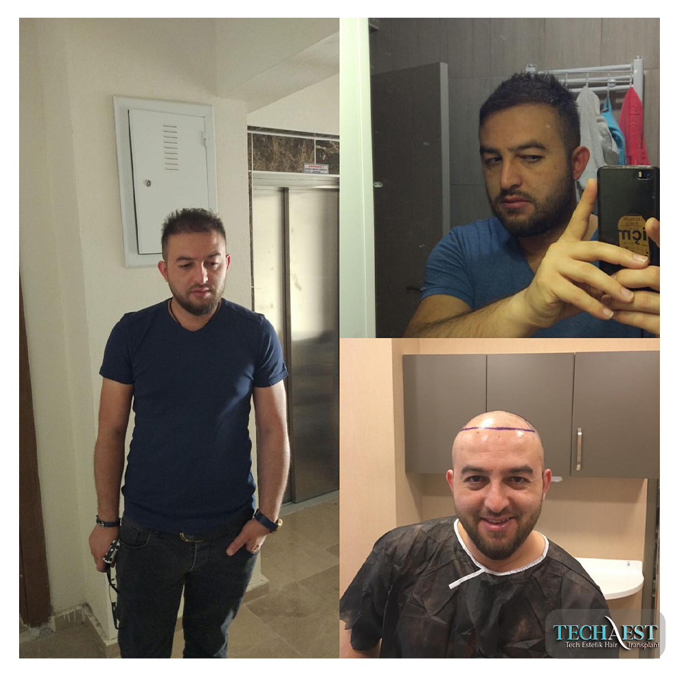 Tech Estetik Saç Ekim Sonuçları 03
