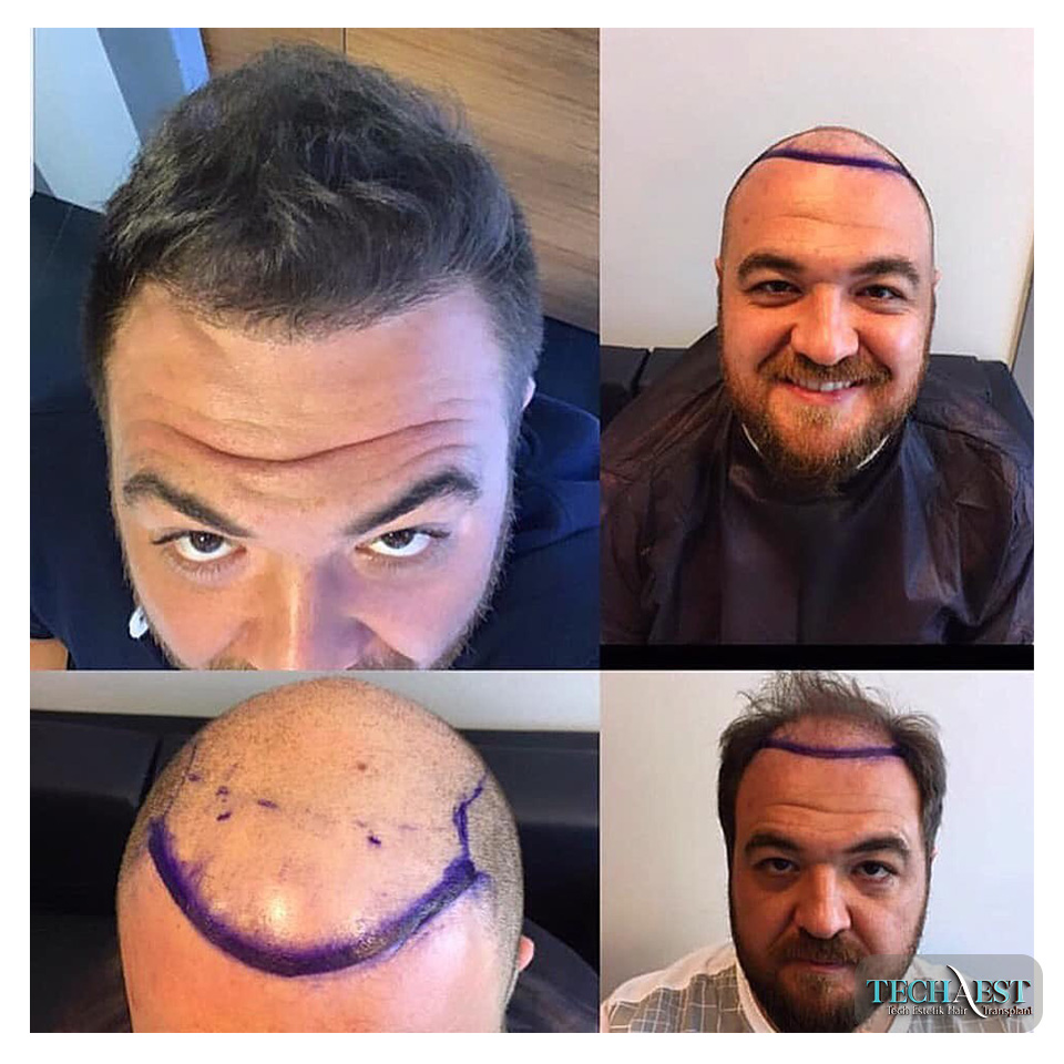 Tech Estetik Saç Ekim Sonuçları 04